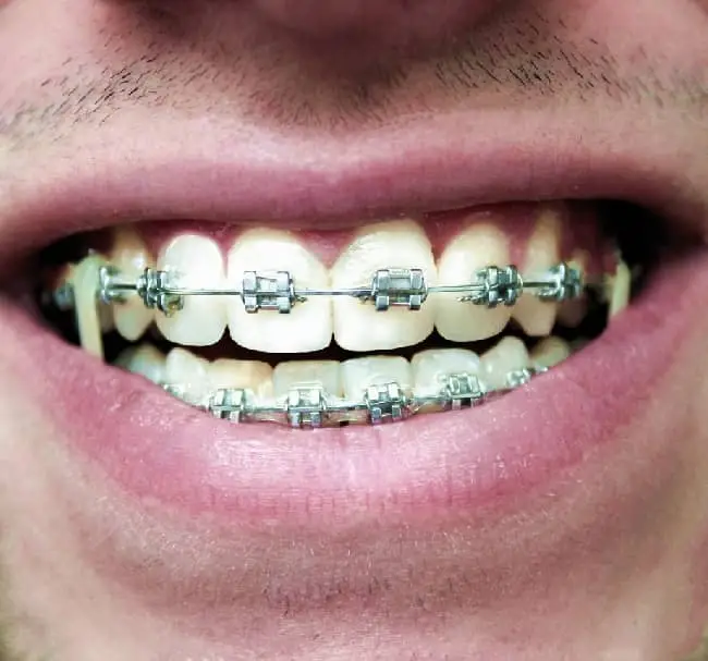 klassische feste Zahnspange